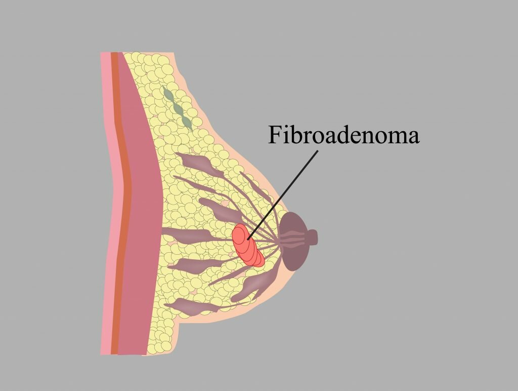 удаление фиброаденомы молочной железы